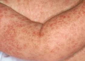 Симптомы мышиной лихорадки Симптомы мышиной лихорадки