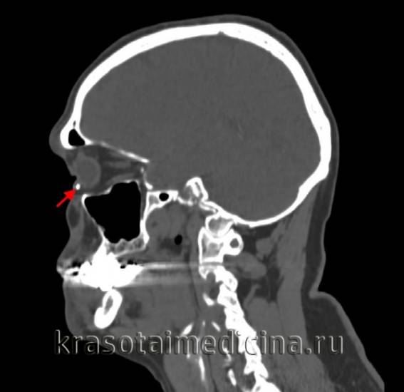 КТ головы. Плотное инородное тело, повреждающее склеру и роговицу. КТ головы. Плотное инородное тело, повреждающее склеру и роговицу.