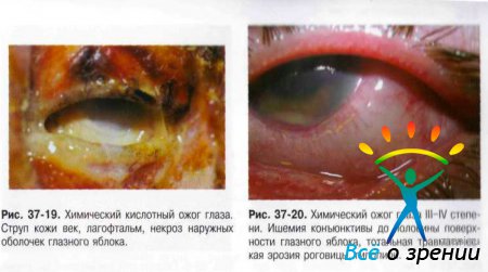 Ожог роговицы глаза код мкб 10