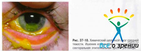 Ожог роговицы глаза код мкб 10