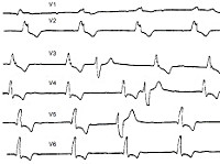 Синдром Морганьи-Адамса-Стокса Синдром Морганьи-Адамса-Стокса