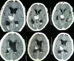 синдром гипертензионно гидроцефальный