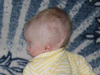 легкий гипертензионно гидроцефальный синдром