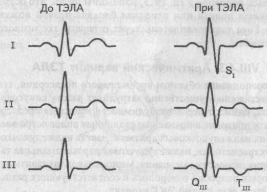 Электрокардиографический синдром SI-QIII-TIII Электрокардиографический синдром SI-QIII-TIII