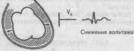 Эксудативный перикардит Эксудативный перикардит
