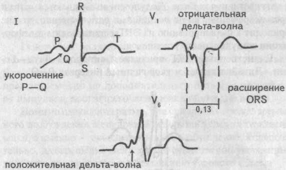 ЭКГ при синдроме WPW, тип В ЭКГ при синдроме WPW, тип В