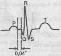 ЭКГ при синдроме Лаун—Генон—Ливайна ЭКГ при синдроме Лаун—Генон—Ливайна