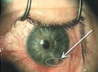 Инородные тела глаза Инородные тела глаза