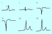 Синдром WPW Синдром WPW