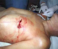 Ранения сердца