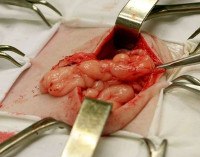 Эвентрация