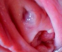 Парауретральная киста