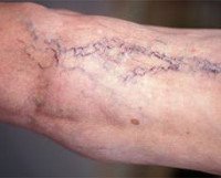 Варикозная болезнь (варикоз)