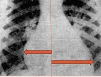 Неревматические кардиты у детей