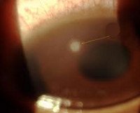 Язва роговицы