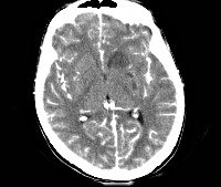 Менингоэнцефалит