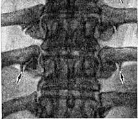 Спондилоартроз