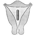 Инородное тело матки