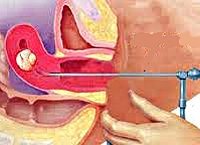 Инородное тело матки