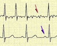 Мерцательная аритмия