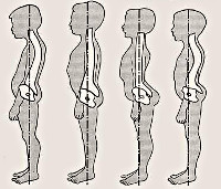 Нарушения осанки у детей