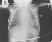 Синдром аспирации мекония