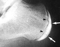 Болезнь Шинца