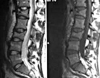 Перелом поясничного отдела позвоночника
