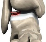 M93.2 Рассекающий остеохондрит