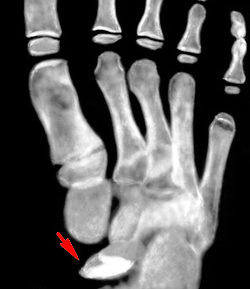 Остеохондропатии