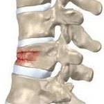 Компрессионный перелом позвоночника