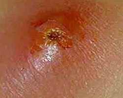 Фурункулез