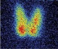 Диффузный эутиреоидный зоб