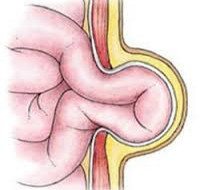 Грыжа живота