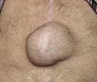 Послеоперационная грыжа