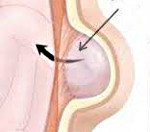 Грыжа спигелиевой линии живота