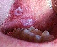 Декубитальная язва полости рта
