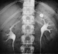 Камни в почках