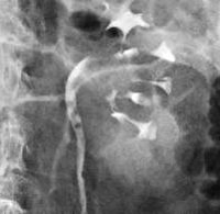 Опухоли мочеточника