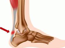 Ахиллобурсит