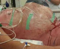 Абдоминальный компартмент-синдром