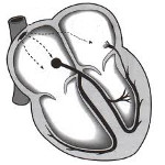 Синдром WPW Синдром WPW