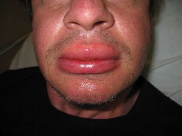 Код мкб отек квинке