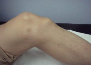 Остеохондропатия надколенника код мкб