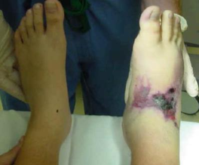 патогенез краш синдрома