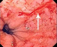Синдром Меллори-Вейса Синдром Меллори-Вейса