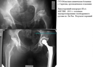 Коксартроз артроз тазобедренного сустава M16