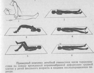 Код мкб воронкообразная грудная клетка