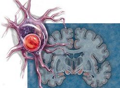 Нейродегеративные заболевания и их причины