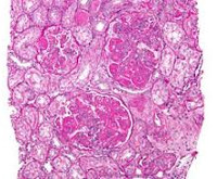 Волчаночный нефрит Волчаночный нефрит